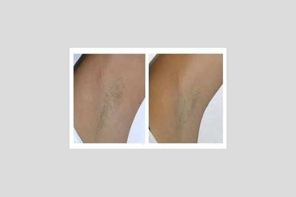Laser hair removal - underarms