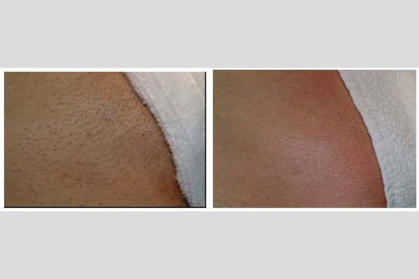 Laser hair removal - bikini area