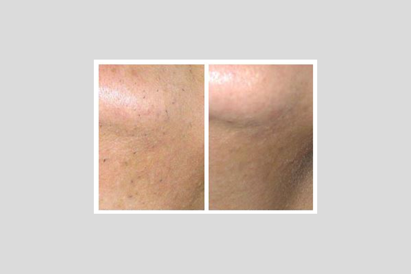 Laser hair removal - chin