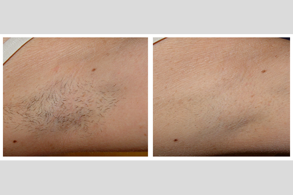 Laser hair removal - underarms