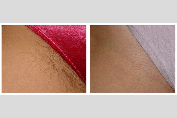 Laser hair removal - bikini area