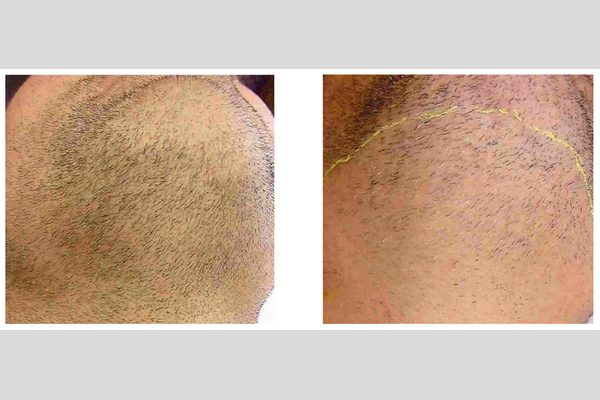 Laser hair removal - Beard