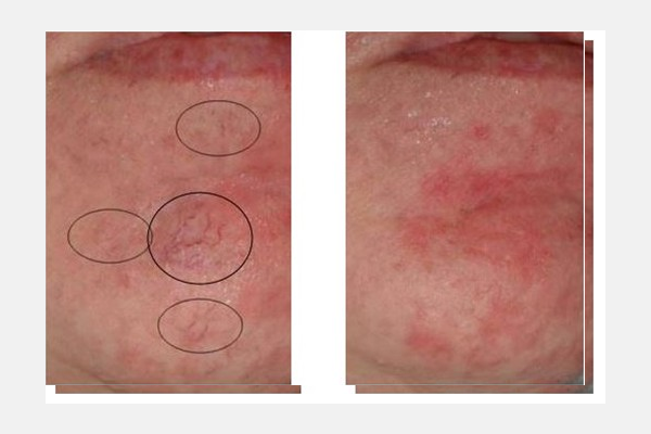 Female Chin with Fine Telangiectasia