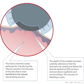 DermaFrac treatment