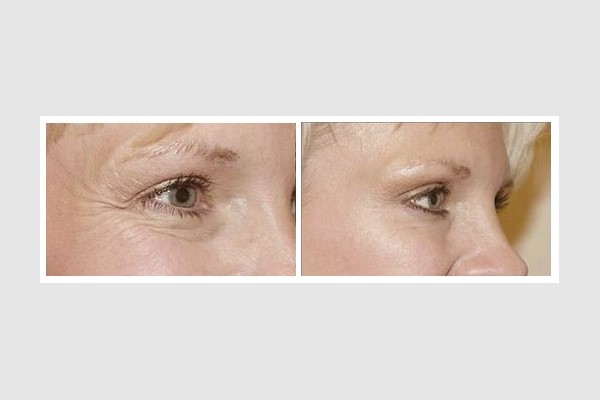 BOTOX and Dysport Crows Feet Treatment