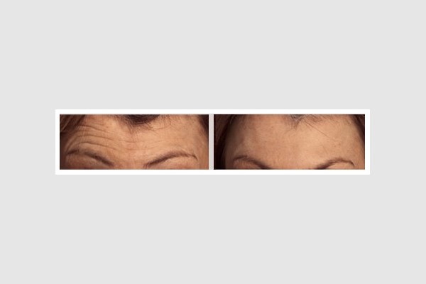 BOTOX and Dysport Forehead Lines Treatment