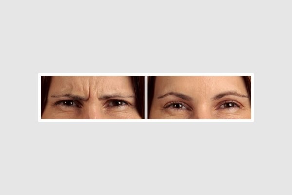 BOTOX and Dysport Glabellar Lines Treatment