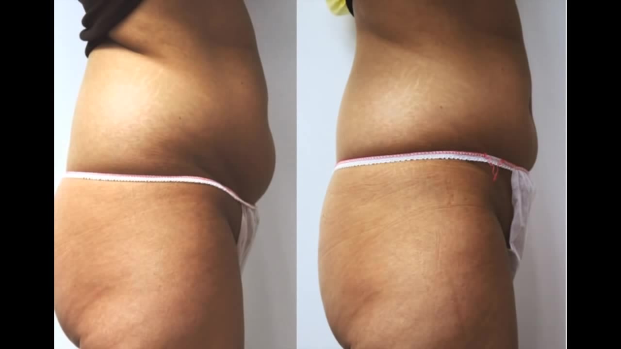 Contorno Corporal - El Tratamiento BTL CELLUTONE ™ - resultados 6