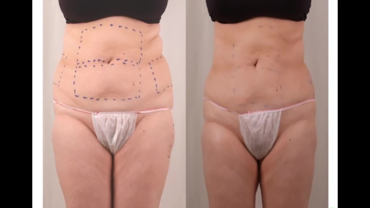 Contorno Corporal - El Tratamiento BTL CELLUTONE ™ - resultados 7