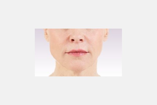 Juvederm Nasolabial Folds Treatment - After