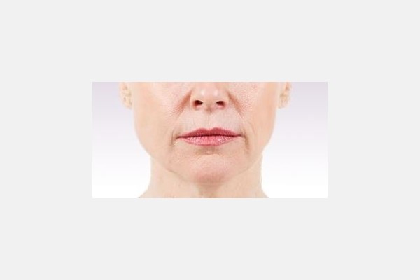 Juvederm Nasolabial Folds Treatment - Before