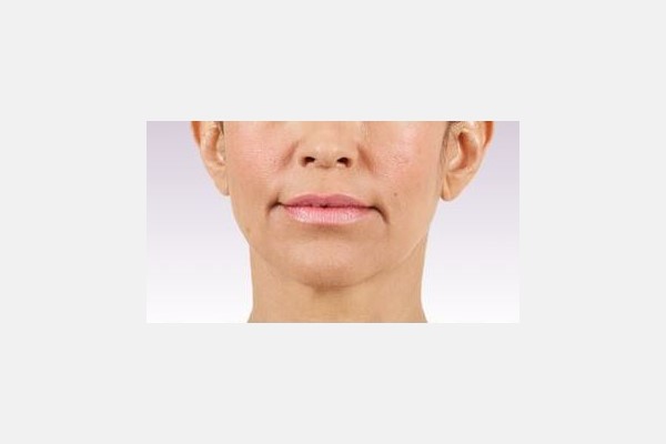 Botox before - Glabellar Lines