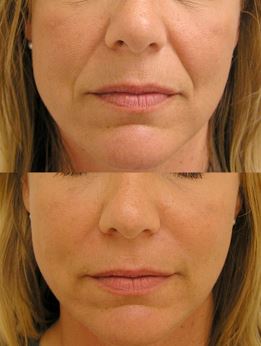 JUVEDERM® Injectable Gel