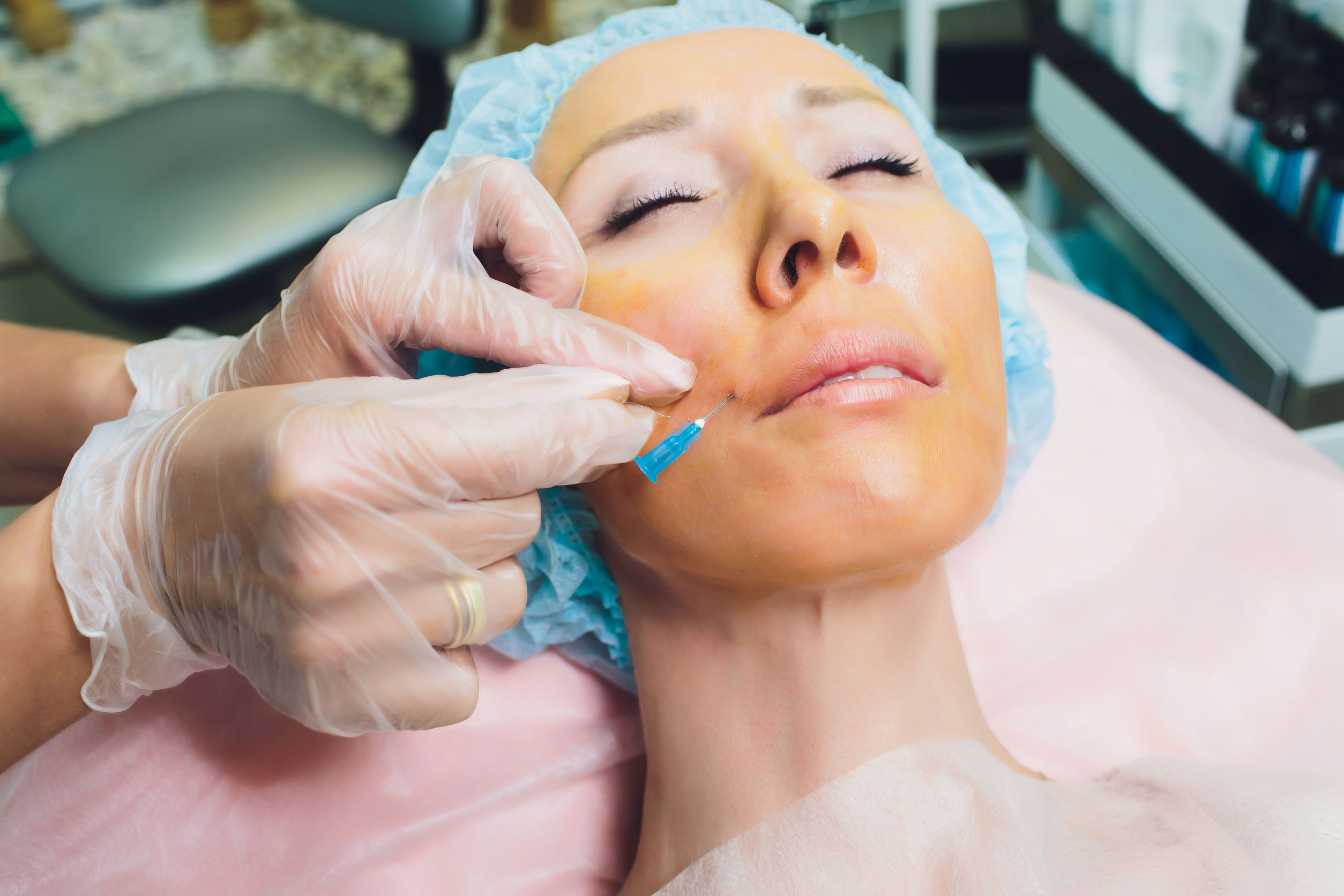 Cosmetic Threading Procedure - Face Lift - 3